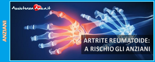 Artrite reumatoide: cause, sintomi e possibili cure!