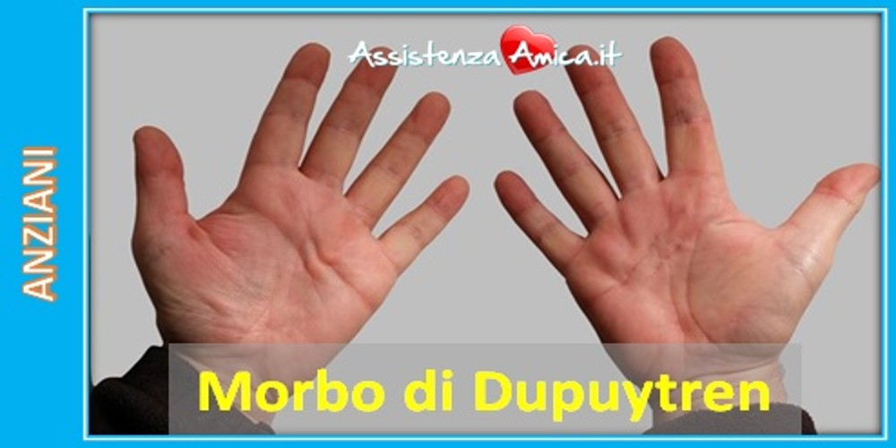 Deformità della mano: il morbo di Dupuytren