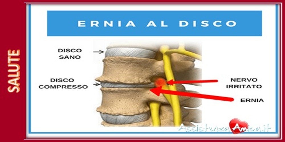 Ernia del disco: Sintomi, Cause e Rimedi!