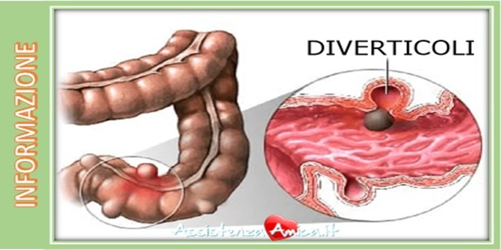 Da cosa è causata la diverticolite e come si cura?