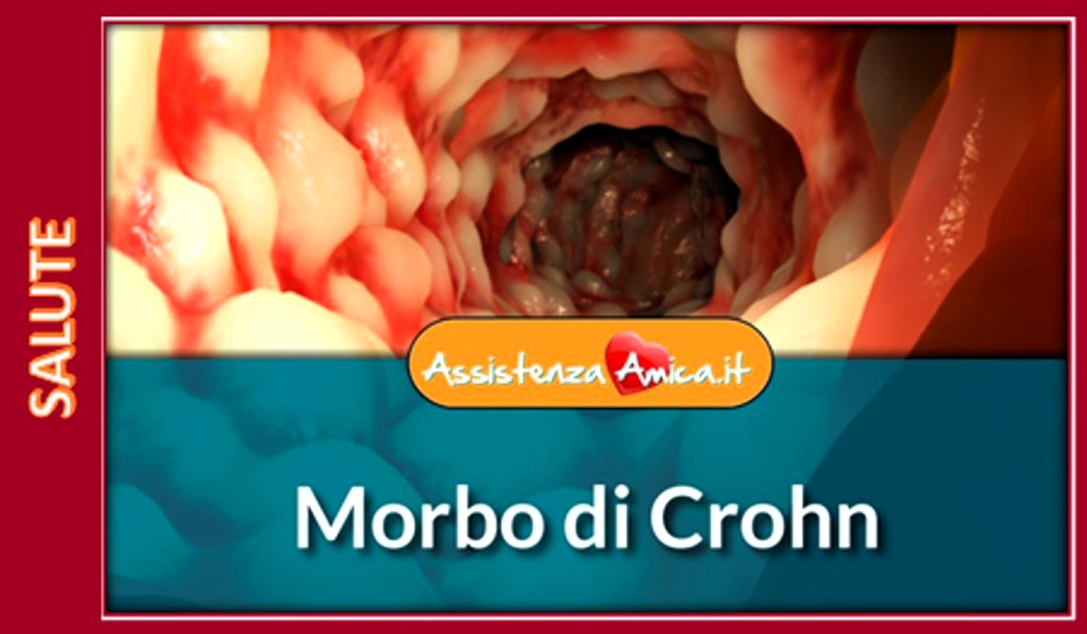 Morbo di Crohn: cos’è e come si cura